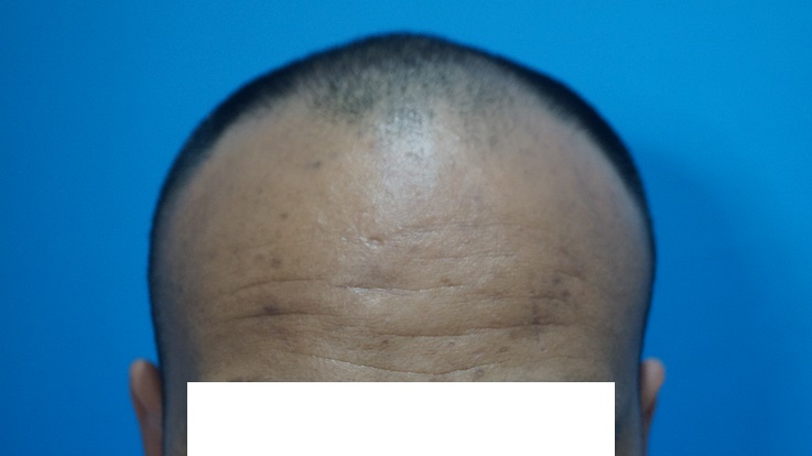 preop-2