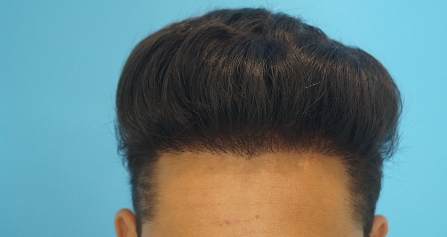 after-1-yr-2
