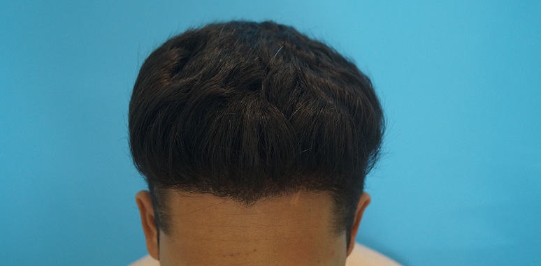 after-1-yr-2