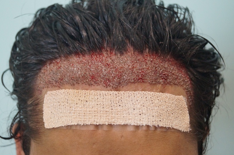 imm-post-op-2