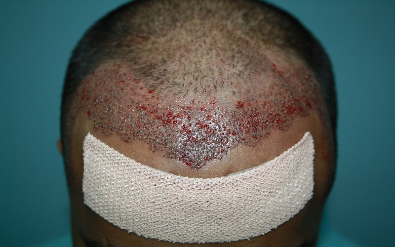 immiedate-post-op-21