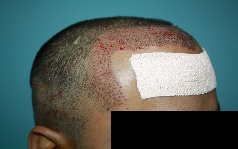 immiedate-post-op-2