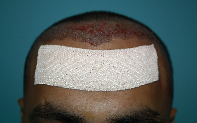 immiedate-post-op-22