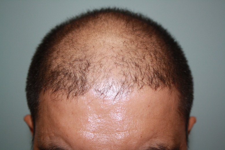 preop pic 2