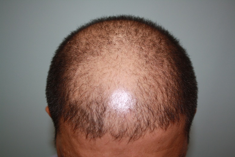 preop pic 3