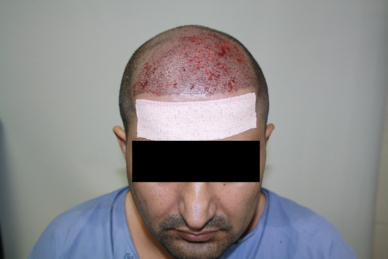 imm post op 1 (patient 5)