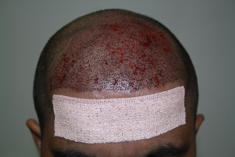 imm post op 2 (patient 5)
