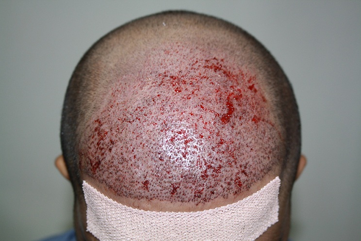 imm post op 3 (patient 5)