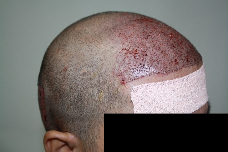 imm post op 4 (patient 5)