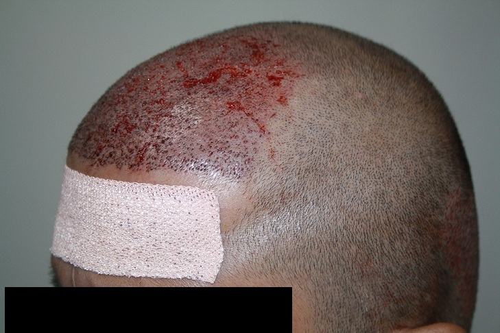 imm post op 5 (patient 5)