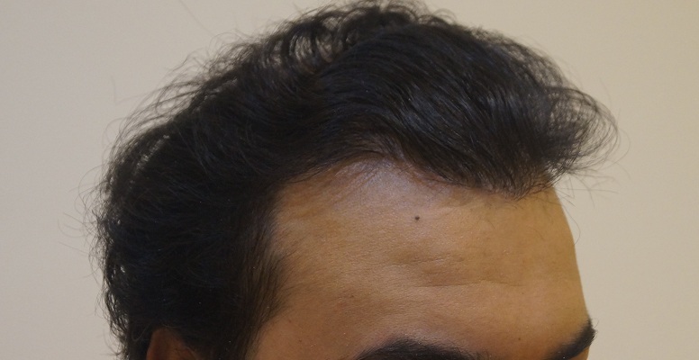 result after 1.5 year