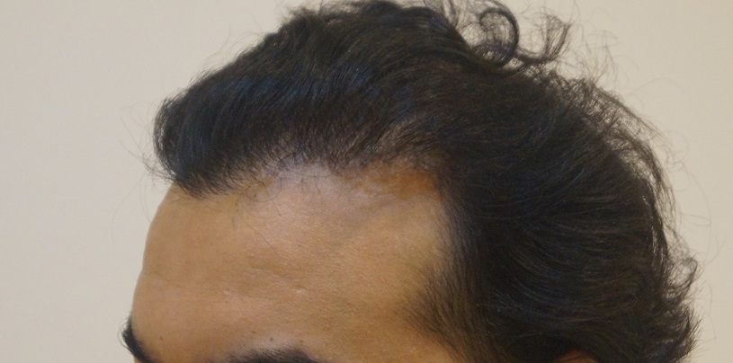 result after 1.5 year b