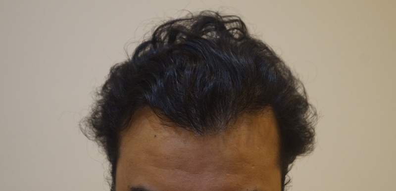 result after 1.5 year v