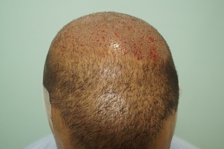 2nd Imm Post Op (2)3