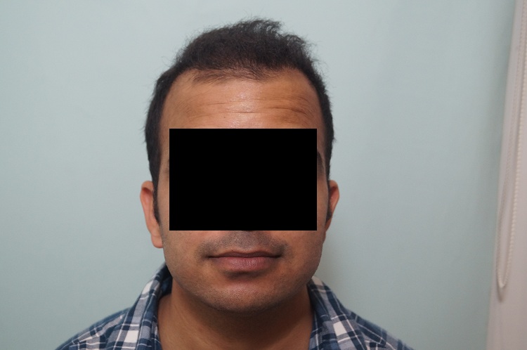 2nd Preop or 1st Result (1)