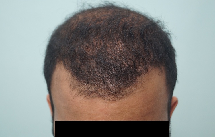 2nd Preop or 1st Result (2)