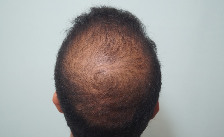 2nd Preop or 1st Result (3)