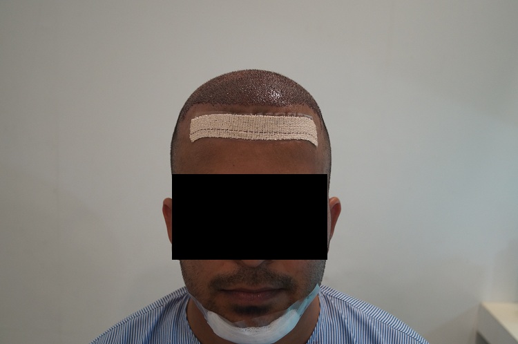 First Imm Post Op (1)