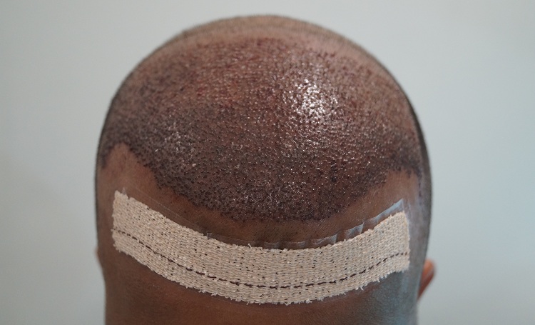 First Imm Post Op (2)