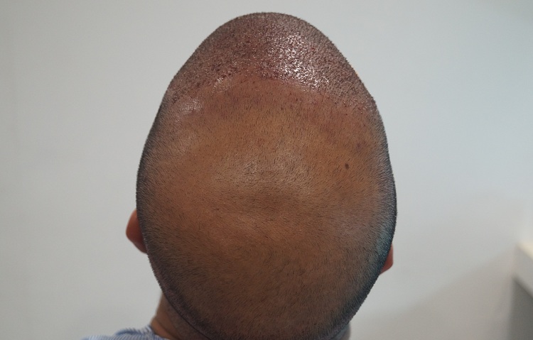 First Imm Post Op (3)