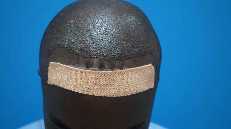 Imm Post Op (1) Patient