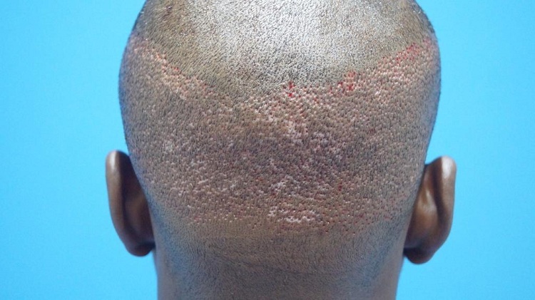 Imm Post Op (4) Patient