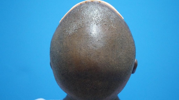 Imm Post Op (5) Patient