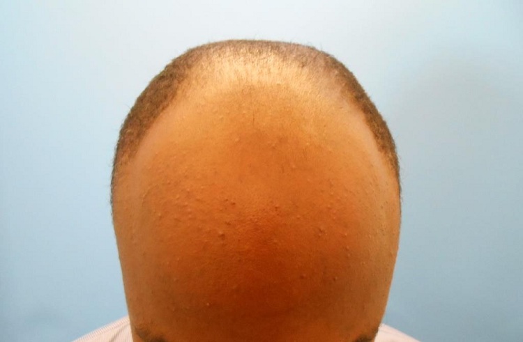 PreOp (1) Curly Hair Patient Result