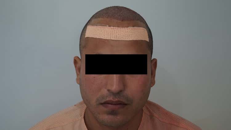 immiedate post op (1)-min