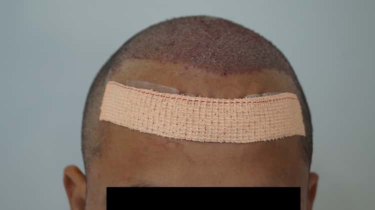 immiedate post op (2)-min