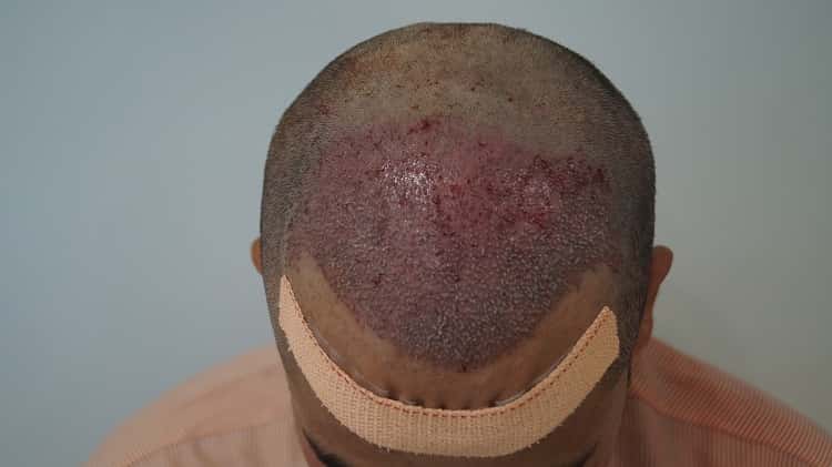 immiedate post op (3)-min