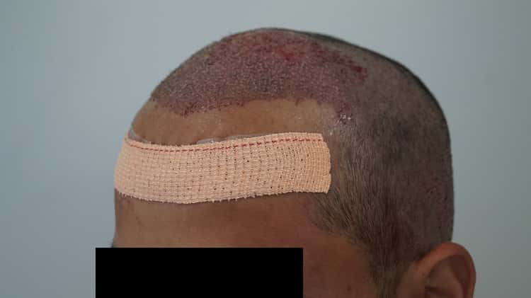 immiedate post op (4)-min