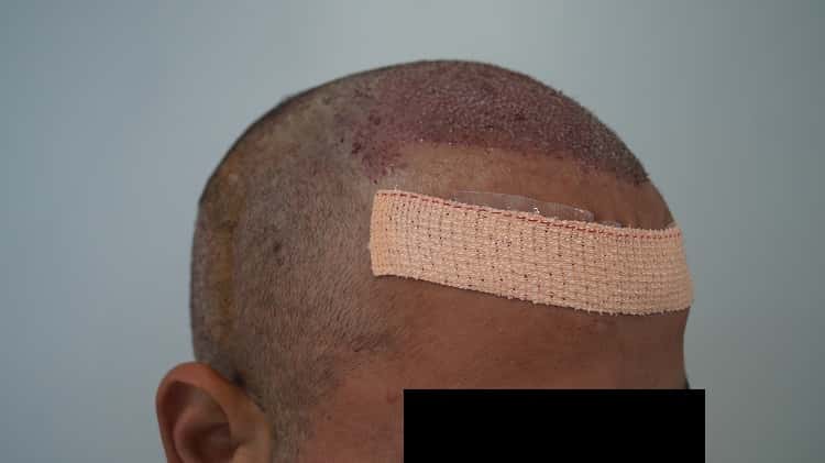 immiedate post op (5)-min