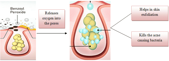 Acne treatment with Benzoyl peroxide