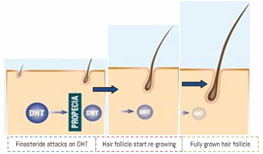 How Finasteride stimulates Hair re-growth