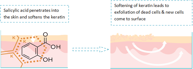 Acne treatment with Salicylic Acid
