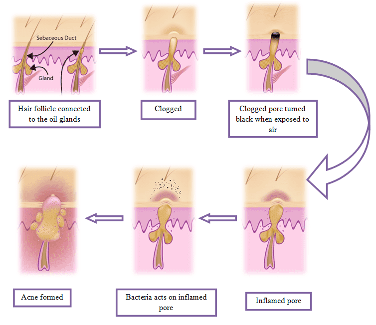 process of acne formation