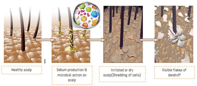 Microbes behind dandruff