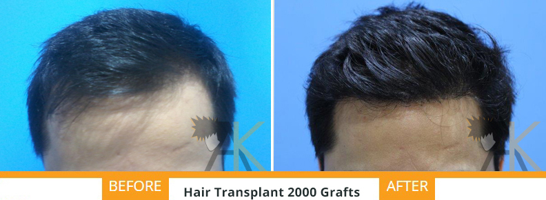 Result of our patient's good result 2000 grafts