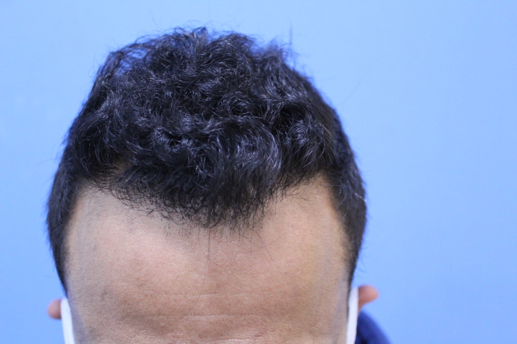 FUT Hair Transplant Result