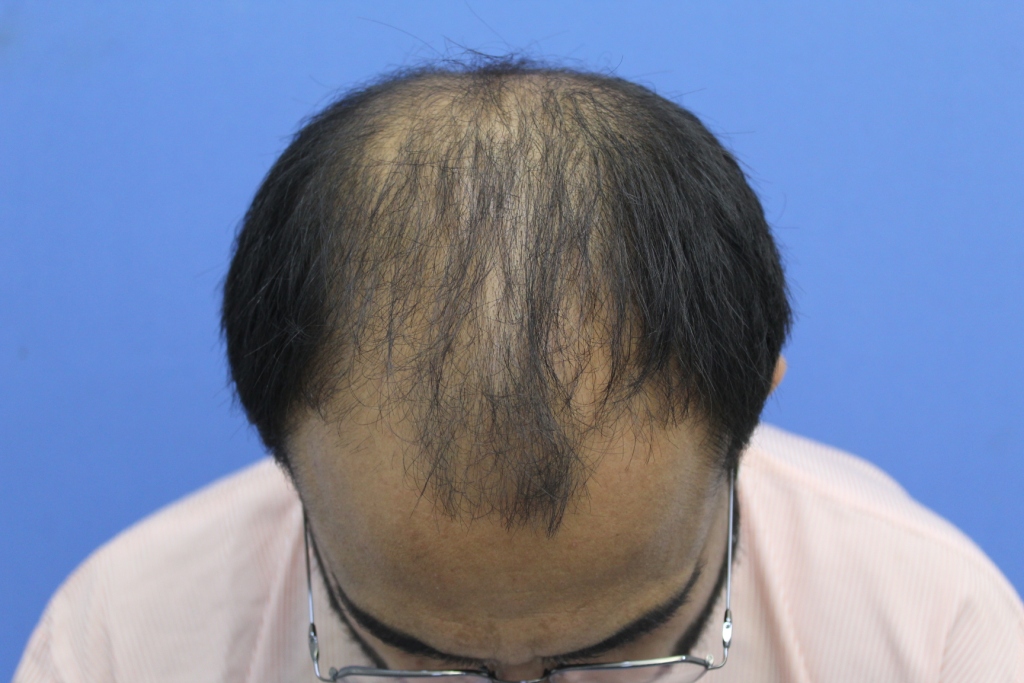 Before FUE Hair Transplant