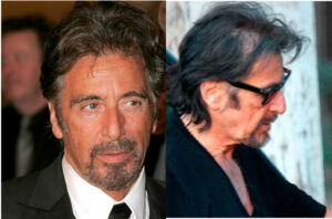 Al-Pacino-Hair transplant
