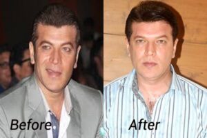aditya pancholi hair transplant