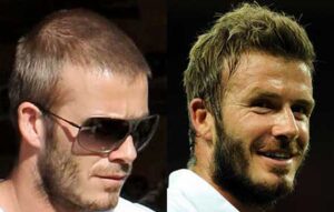 david-beckham-hair-transplant