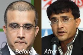 saurav ganguly hair transplant