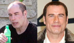john-travolta-hair-transplant