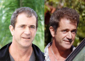 mel gibson hair transplant