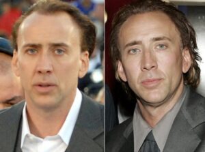 nicolas-cage-hair-transplant