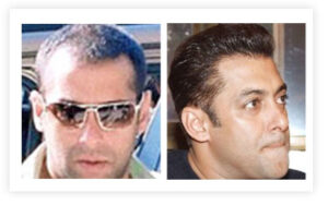 Salman Khan Hair Transplant Before and After