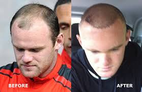 wayne rooney hair transplant